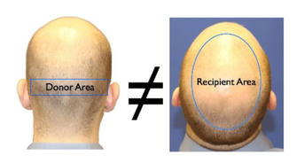 Hair Transplants: Your Path to a Fuller, Confident Head of Hair